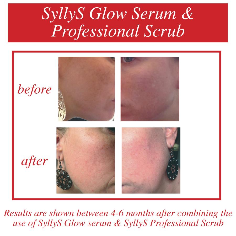 A before and after image of the invisibility of pigmentation on a SyllyS of Switzerland client’s cheeks after using SyllyS Glow Serum a Concentrated Stable Vitamin C with SyllyS Professional Scrub for 4-6 months.